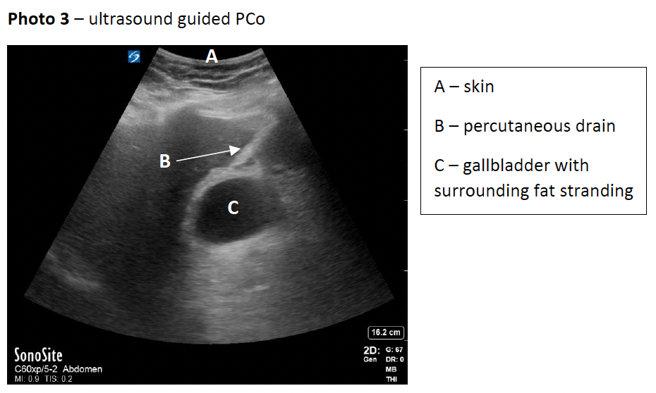 Percutaneous Cholecystostomy For Management Of Acute Acalculous ...